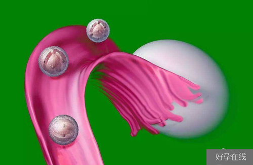 肌醇胆碱与多囊卵巢