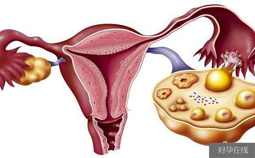 多囊卵巢综合征试管婴儿注意事项